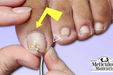 👣Pedicure Ingrown Fungal Toenail👣