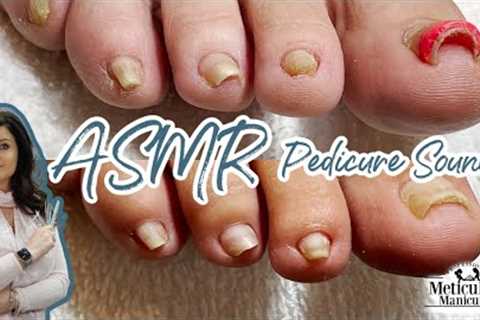 👣ASMR Pincer Big Toenail Pedicure Transformation Progress👣