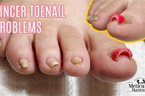 👣Pedicure Tutorial on Pincer Toenails that Cause Pain👣