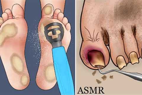 ASMR Climber''s plantar calluses and rot toenails care animation