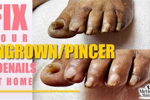 👣Fix your Ingrown Pincer Toenails at Home👣