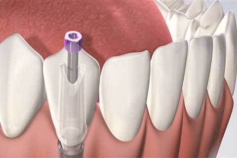 How Much Do Dental Implants Cost? Breaking Down the Expenses