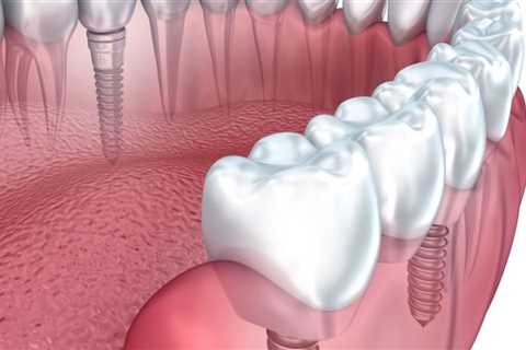 How are dental implants placed