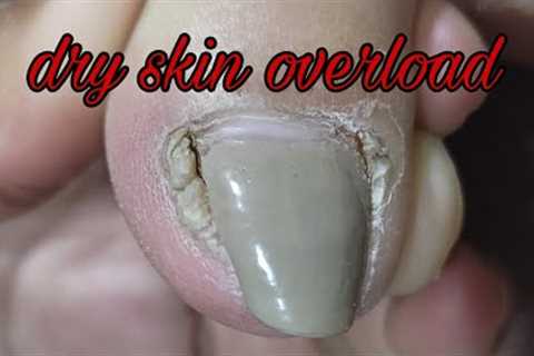 VLOG #59 INGROWN DRY SKIN REMOVAL TOENAIL @aibeautytv