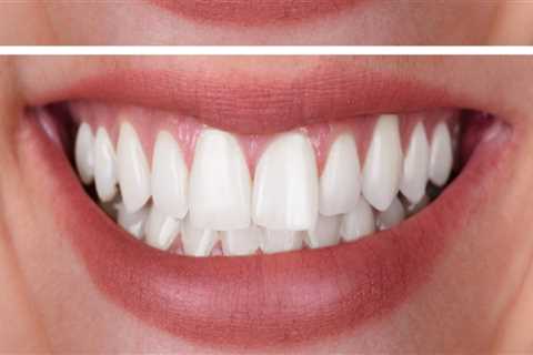 Teeth Whitening: Safe and Effective Methods Revealed