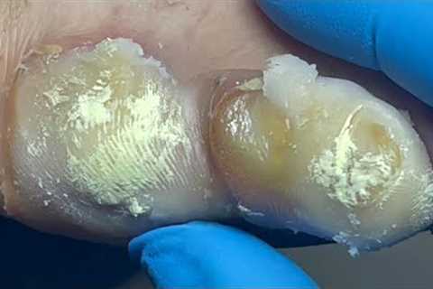 Bacterial infection of the toenails, removal of large amounts of dead skin【Pedicure Master Lin Jun】