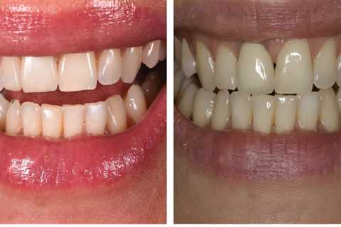 How much is Dental Implants