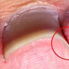 Super obvious ingrown toenail, completely repaired【Crazy pedicure room】