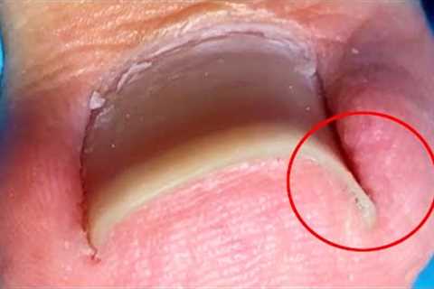 Super obvious ingrown toenail, completely repaired【Crazy pedicure room】