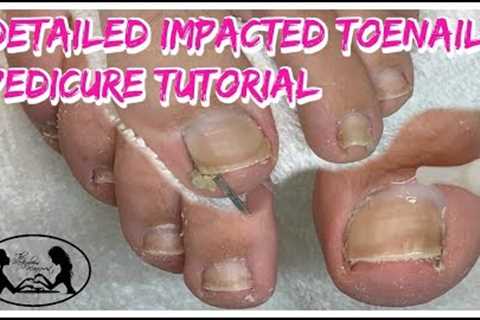 👣 Satisfying Impacted Toenail Cleaning Pedicure Tutorial Detailed Instruction  👣⭐